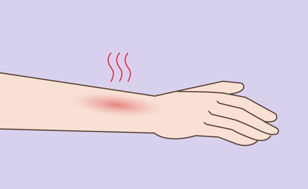 Illustration of burning skin Card Illustration of burning skin