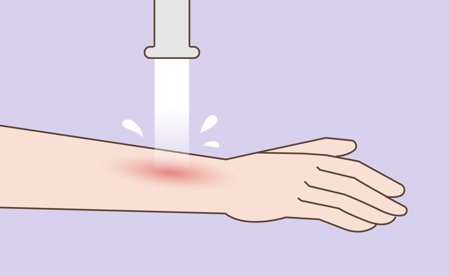 Applying water on burnt skin Card image of Applying water on burnt skin