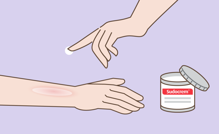 Application of Sudocrem on burnt skin Card image of Application of Sudocrem on burnt skin