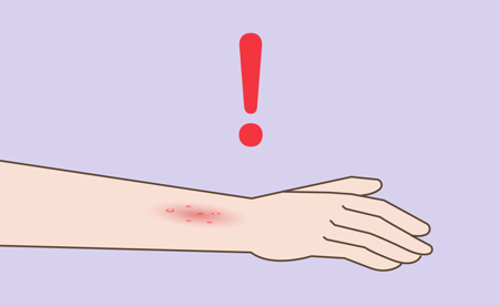 Exclamation point next to burnt arm  Image of Exclamation point next to burnt arm