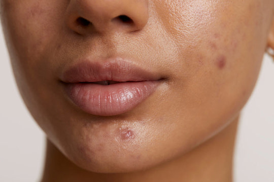 Image for Acne uses