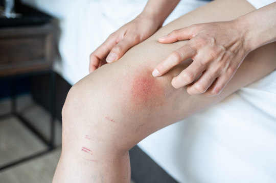 Image for Chafing uses